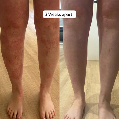 Before and after comparison of legs showing improvement over 3 weeks on a wooden floor.