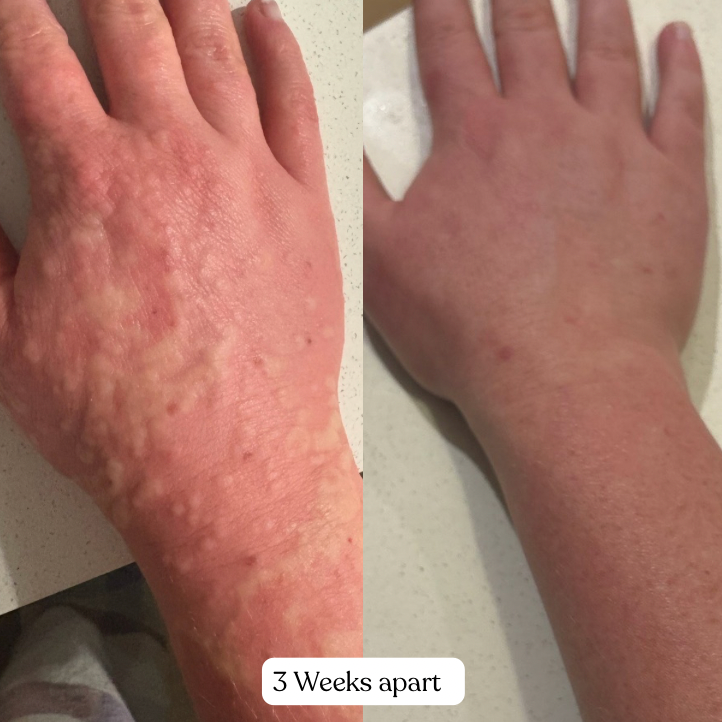 Before and after comparison of a hand with visible skin conditions, labeled '3 Weeks apart'.