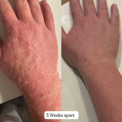 Before and after comparison of a hand with visible skin conditions, labeled '3 Weeks apart'.